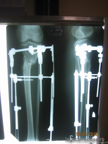 рентген - 4 месяца