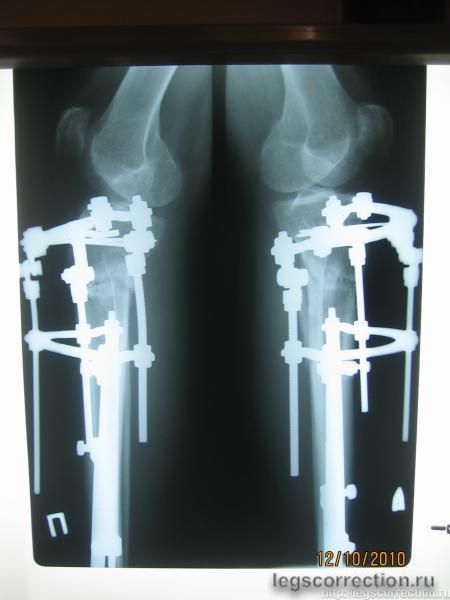 рентген - 4 мес 28 дней - боковая проекция