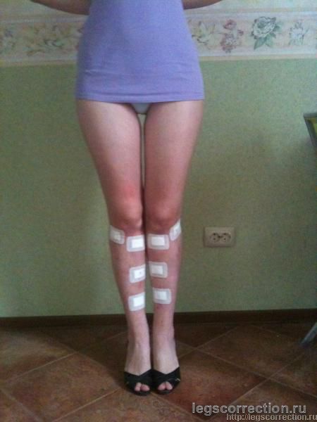 3 дня после снятия на каблуках