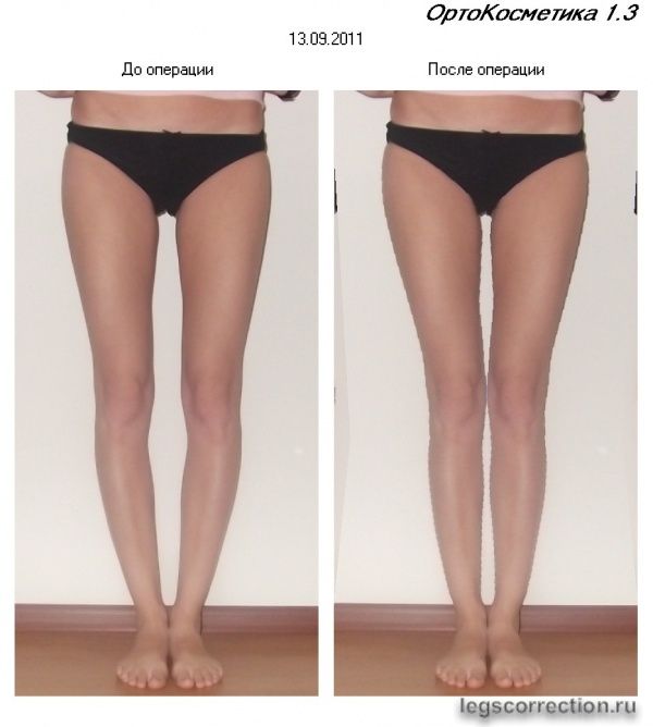 Ноги до операции, моделирование.