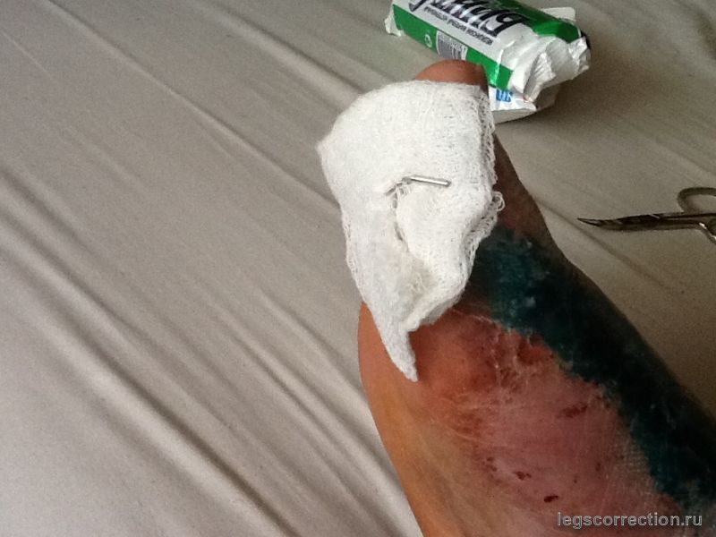 Операция Hallus Valgus