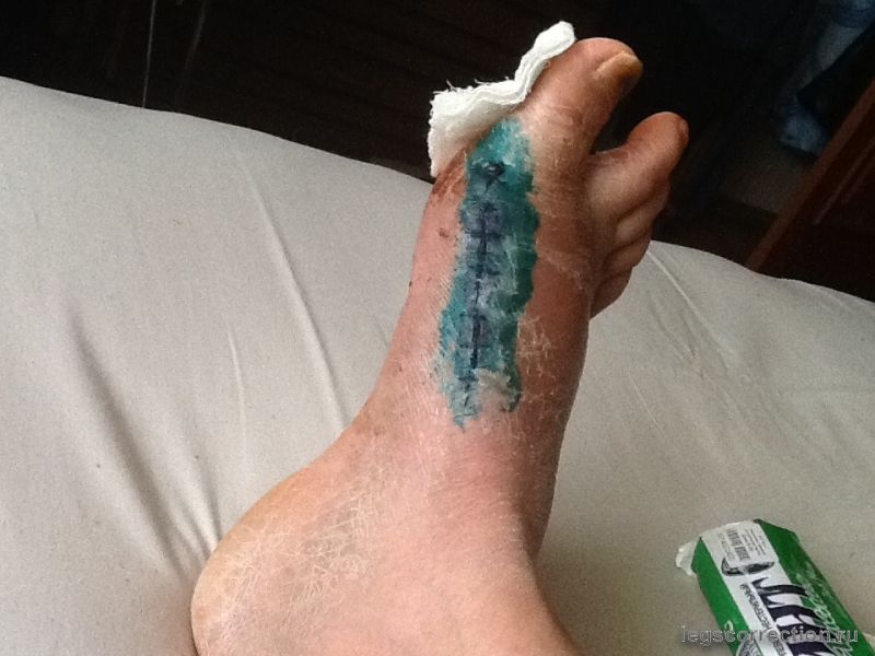 Операция Hallus Valgus