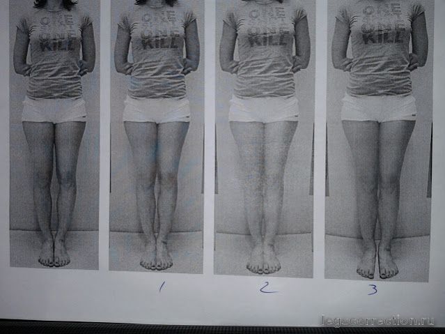 Legs