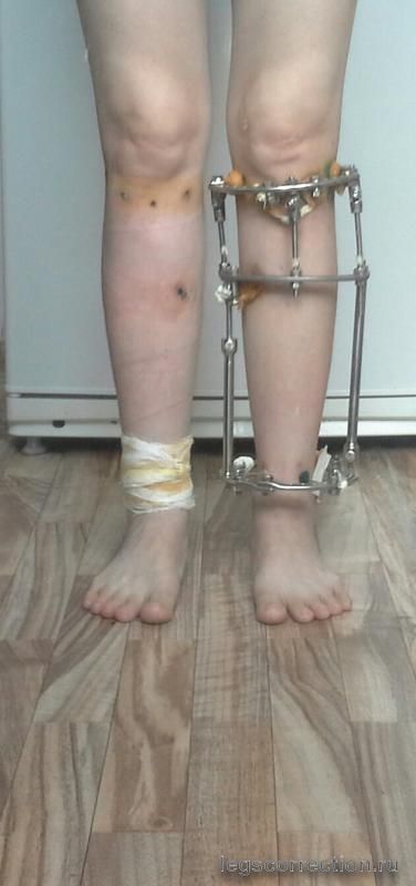 снят аппарат с левой