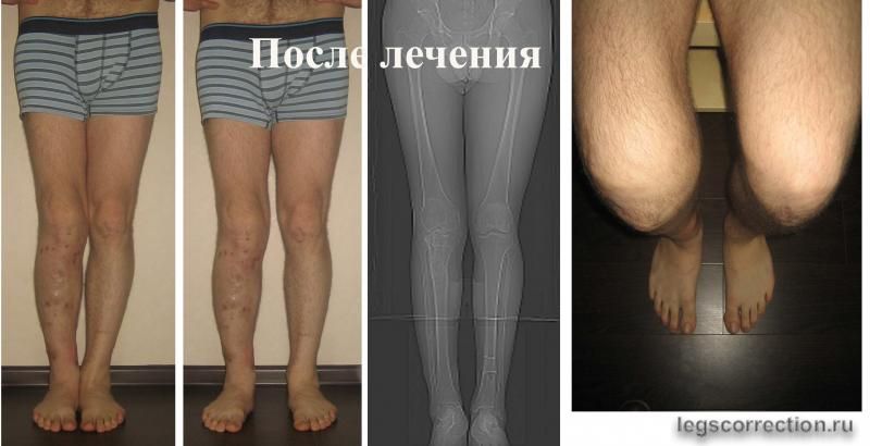 после лечения