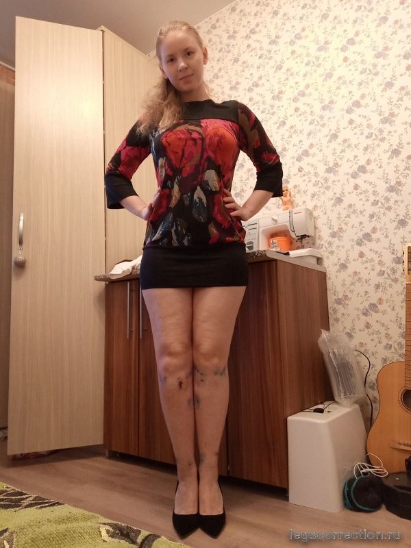 Сняла аппараты