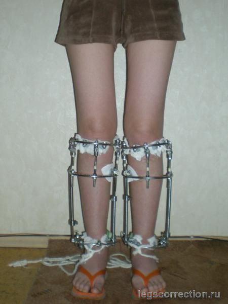 фиксация