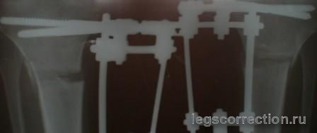 ренген 38 дней после оп