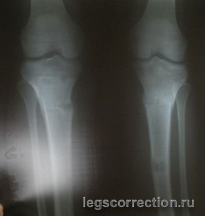 Ренген через 2 нед. после снятия