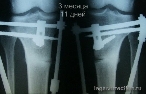 Метаморфозы моих ножек
