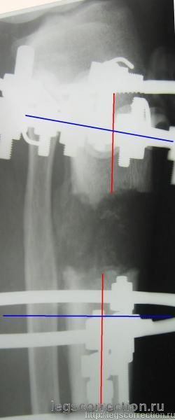 рентген справа сбоку дистракция 4 см