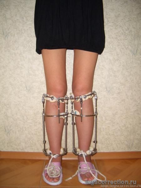 Фиксация