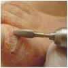 удаление пораженных частей ногтя